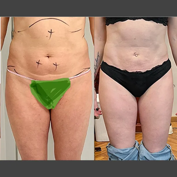 Intervento svolto in anestesia locale con sedazione, durata 2 h. In questo caso specifico la paziente presenta degli accumuli localizzati nella zona addome e fianchi. I fori di entrata delle microcannule sono stati effettuati all'interno degli slip. La paziente presentava prima dell’intervento delle aderenze nella zona del basso ventre.