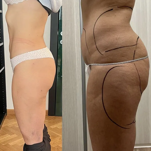 Intervento svolto in anestesia locale con sedazione, durata 1:40 h. In questo caso specifico la paziente presenta degli accumuli localizzati nella zona addome, fianchi e culotte de cheval. I fori di entrata delle microcannule sono stati effettuati all'interno degli slip così da essere poco visibili e nella zona del sottogluteo.