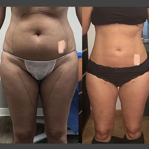 Intervento svolto in anestesia locale con sedazione, durata 2 h. In questo caso specifico la paziente presenta degli accumuli localizzati nella zona addome, fianchi ed interno coscia. I fori di entrata delle microcannule sono stati effettuati all'interno degli slip così da essere poco visibili e nella parte mediana della coscia.