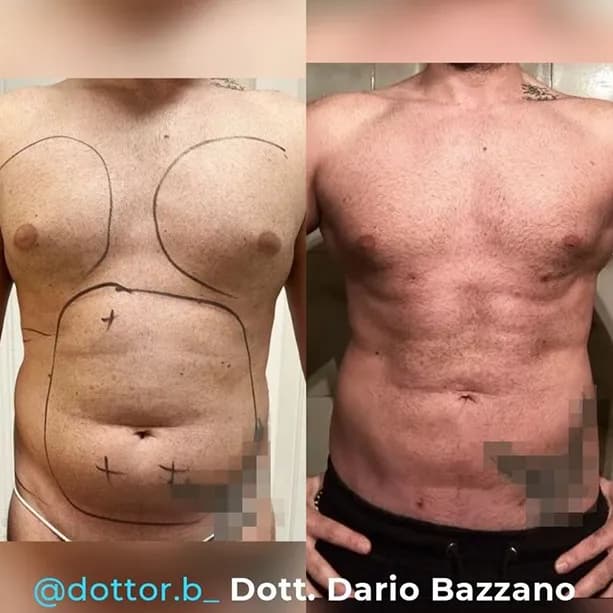 Intervento svolto in anestesia locale con sedazione, durata 1:45 h. In questo caso specifico il paziente presenta degli accumuli localizzati nella zona addome, fianchi e pettorale. I fori di entrata delle microcannule sono stati effettuati nell'interno della zona del pettorale e all'interno degli slip così da essere poco visibili.