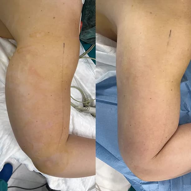 Intervento svolto in anestesia locale con sedazione, durata 1:10 h. In questo caso specifico la paziente presenta degli accumuli localizzati nella zona delle braccia. I fori di entrata delle microcannule sono stati effettuati nella zona del gomito.