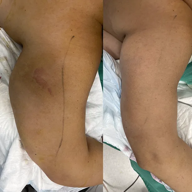 Intervento svolto in anestesia locale con sedazione, durata 1 h. In questo caso specifico la paziente presenta degli accumuli localizzati nella zona delle braccia. I fori di entrata delle microcannule sono stati effettuati nella zona del gomito.