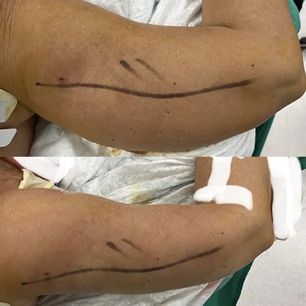 Intervento svolto in anestesia locale con sedazione, durata 1:15 h. In questo caso specifico la paziente presenta degli accumuli localizzati nella zona delle braccia. I fori di entrata delle microcannule sono stati effettuati nella zona del gomito.