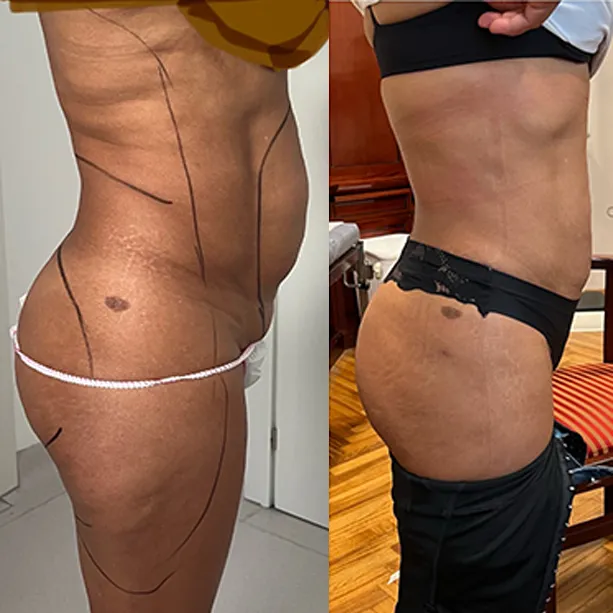 Intervento svolto in anestesia locale con sedazione, durata 1:55 h. In questo caso specifico la paziente presenta degli accumuli localizzati nella zona addome, fianchi e schiena. I fori di entrata delle microcannule sono stati effettuati all'interno degli slip così da essere poco visibili e a livello del reggiseno. I risultati nella foto del post intervento sono a distanza di due mesi con ancora margine di miglioramento, abbiamo ottenuto un notevole miglioramento psicofisico.