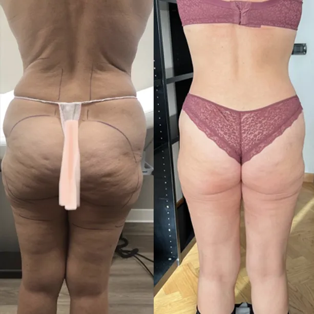 Intervento svolto in anestesia locale con sedazione, durata 2 h. In questo caso specifico la paziente presenta degli accumuli localizzati nella zona fianchi, schiena, culotte de cheval, sottogluteo ed interno coscia. I fori di entrata delle microcannule sono stati effettuati all'interno degli slip così da essere poco visibili, all’interno del reggiseno, nella piega del sottogluteo e nella parte mediana della coscia. Notevole miglioramento generale e notevole miglioramento della circolazione linfatica.