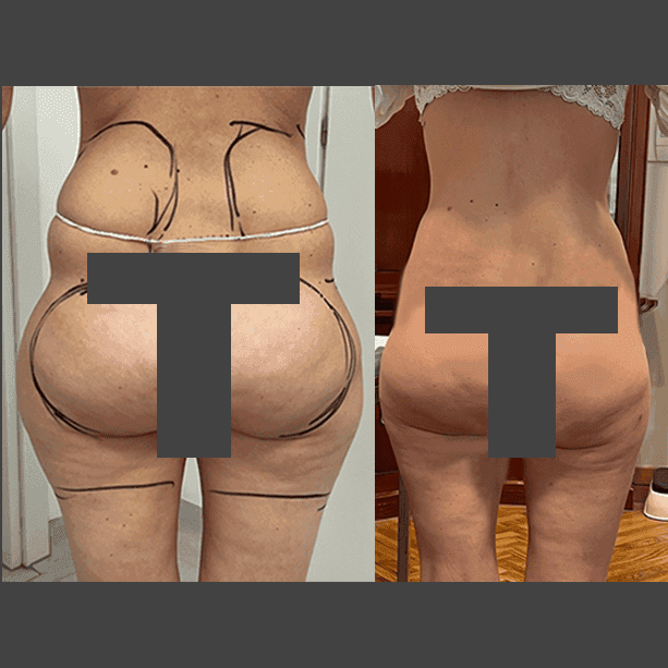 Intervento svolto in anestesia locale con sedazione, durata 2 h. In questo caso specifico la paziente presenta degli accumuli localizzati nella zona fianchi, culotte de cheval, sottogluteo e interno coscia. I fori di entrata delle microcannule sono stati effettuati all'interno degli slip così da essere poco visibili, nella piega del sottogluteo e nella parte mediana della coscia.