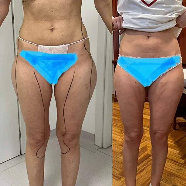 Intervento svolto in anestesia locale con sedazione, durata 1:50 h. In questo caso specifico la paziente presenta degli accumuli localizzati nella zona culotte de cheval, fianchi, interno coscia ed interno ginocchia. I fori di entrata delle microcannule sono stati effettuati nella parte mediana della coscia e nella zona interna delle ginocchia.