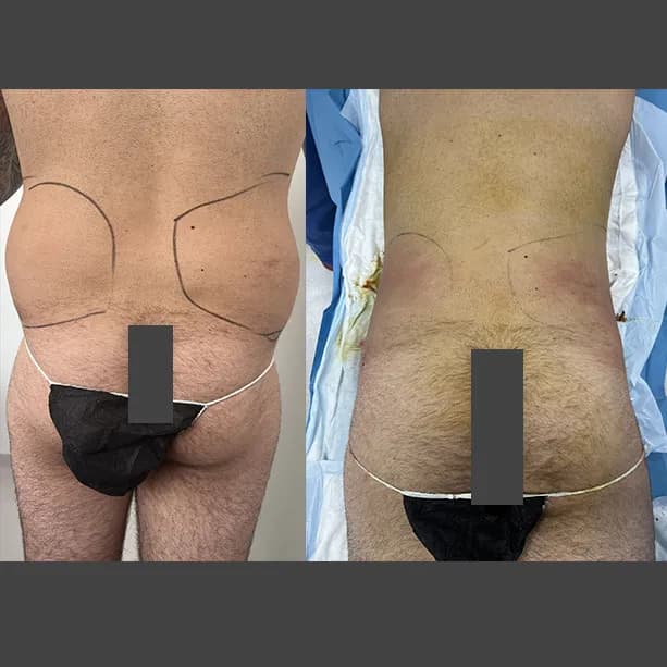 Intervento svolto in anestesia locale con sedazione, durata 1 h. In questo caso specifico il paziente presenta degli accumuli localizzati nella zona delle maniglie dell'amore. I fori di entrata delle microcannule sono stati effettuati nella zona dei fianchi.