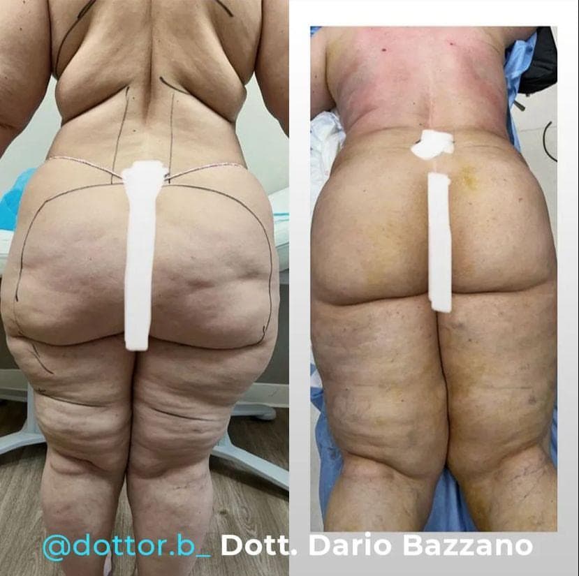 Intervento svolto in anestesia locale con sedazione, durata 1:45 h. In questo caso specifico la paziente presenta degli accumuli localizzati nella zona fianchi, culotte de cheval, interno coscia e sottogluteo. I fori di entrata delle microcannule sono stati effettuati all'interno degli slip così da essere poco visibili, nella piega del sottogluteo e nella parte mediana della coscia.
