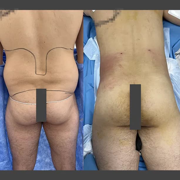 Intervento svolto in anestesia locale con sedazione, durata 1:15 h. In questo caso specifico il paziente presenta degli accumuli localizzati nella zona delle maniglie dell'amore. I fori di entrata delle microcannule sono stati effettuati nella zona dei fianchi.