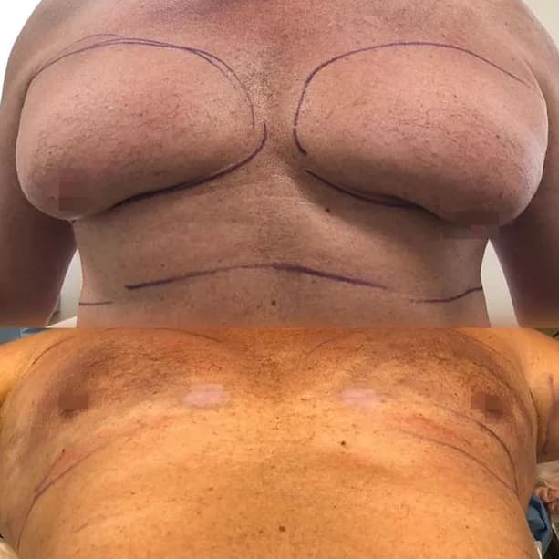 Intervento svolto in anestesia locale con sedazione, durata 1:40 h. In questo caso specifico il paziente presenta degli accumuli localizzati nella zona del pettorale. I fori di entrata delle microcannule sono stati effettuati nell'interno della zona del pettorale. Il paziente presentava un accumulo abnorme con relativo disagio psicologico.