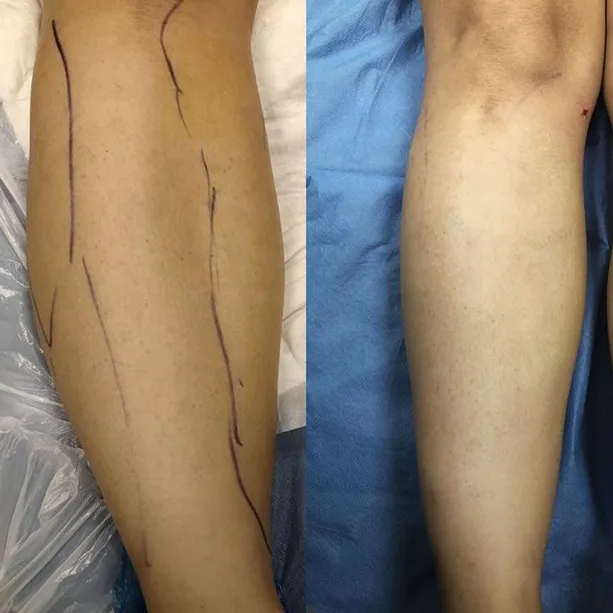 Intervento svolto in anestesia locale con sedazione, durata 1:20 h. In questo caso specifico la paziente presenta degli accumuli localizzati nella zona del polpaccio. I fori di entrata delle microcannule sono stati effettuati nella zona alta delle ginocchia (i fori sono più evidenti perchè all'inizio risultano arrossati ma andranno a sparire nel tempo). La paziente presentava un problema di Lipedema, dolore e disagio; abbiamo risolto queste problematiche.