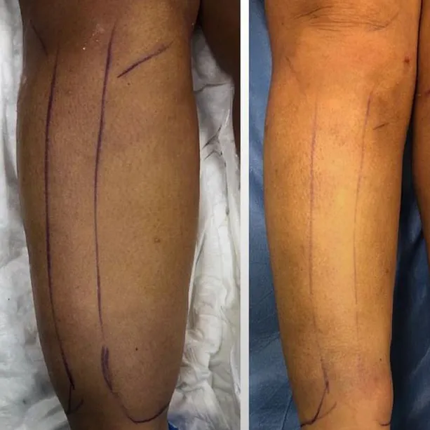 Intervento svolto in anestesia locale con sedazione, durata 1:30 h. In questo caso specifico la paziente presenta degli accumuli localizzati nella zona del polpaccio e della caviglia. I fori di entrata delle microcannule sono stati effettuati nella zona bassa ed interna del ginocchio. La paziente presentava un problema di Lipedema, dolore e disagio; abbiamo risolto queste problematiche.